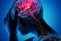 Ilustrasi Gejala Stroke