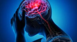 Ilustrasi Gejala Stroke