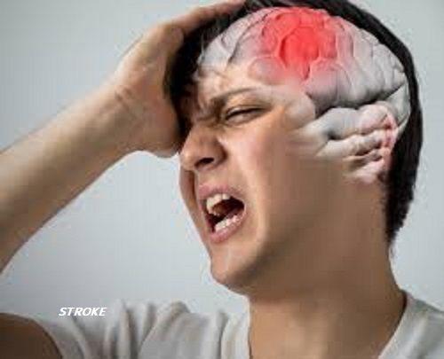 Ilustrasi Penyakit Stroke