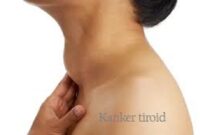 Waspada Kanker Tiroid