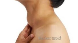 Waspada Kanker Tiroid
