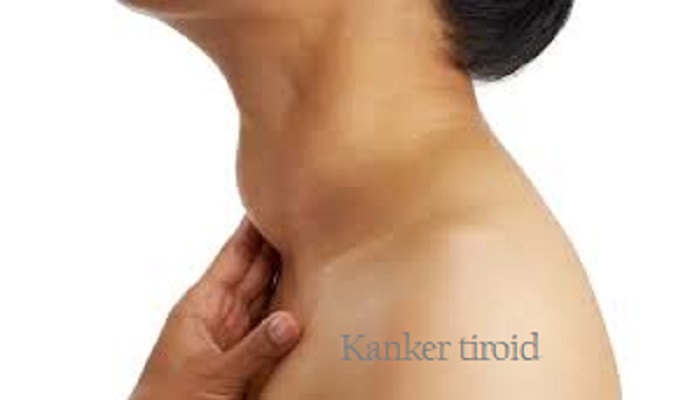 Waspada Kanker Tiroid
