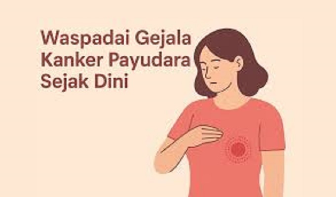 Ilustrasi Kanker Payu Dara. 