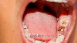 Bahaya Gigi Berlubang