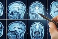 Kebiasaan buruk yang picu tumor otak