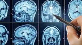 Kebiasaan buruk yang picu tumor otak