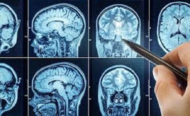 Kebiasaan buruk yang picu tumor otak