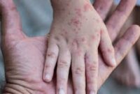 Kasus suspect campak di kota palembang meningkat drastis