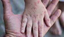 Kasus suspect campak di kota palembang meningkat drastis