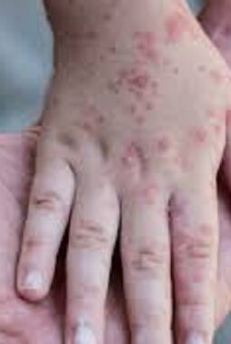 Lonjakan Kasus Campak 2026 Meledak, Dinkes Palembang Genjot ORI: Orang Tua Wajib Waspada!