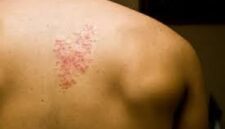 Cara mencegah cacar api