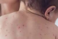 Kerinci waspada penyakit Campak dan DBD