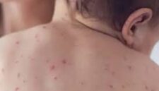 Kerinci waspada penyakit Campak dan DBD