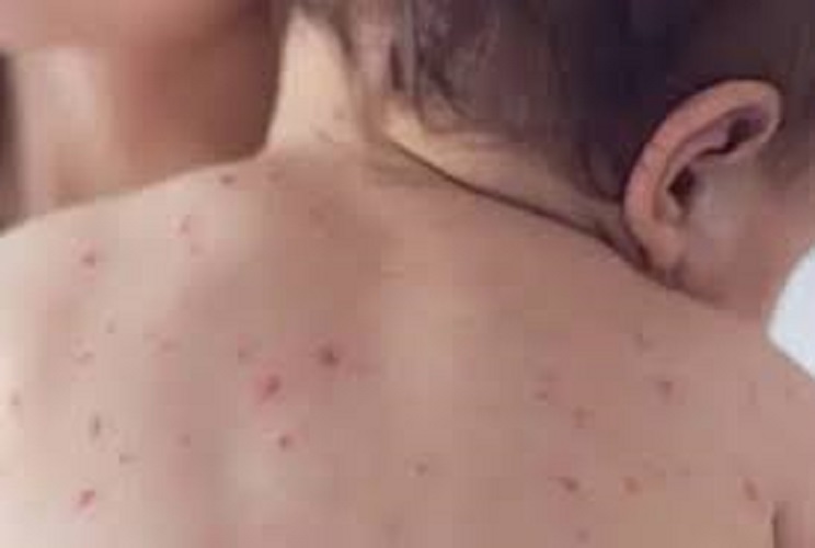 Kerinci waspada penyakit Campak dan DBD