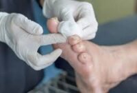 Luka pada pasien pengidap Diabetes susah sembuh