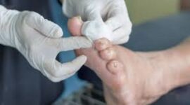 Luka pada pasien pengidap Diabetes susah sembuh