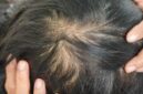 Penyebab rambut menipis