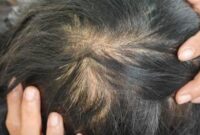 Penyebab rambut menipis