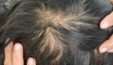 Penyebab rambut menipis