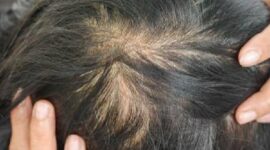 Penyebab rambut menipis
