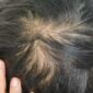 Penyebab rambut menipis